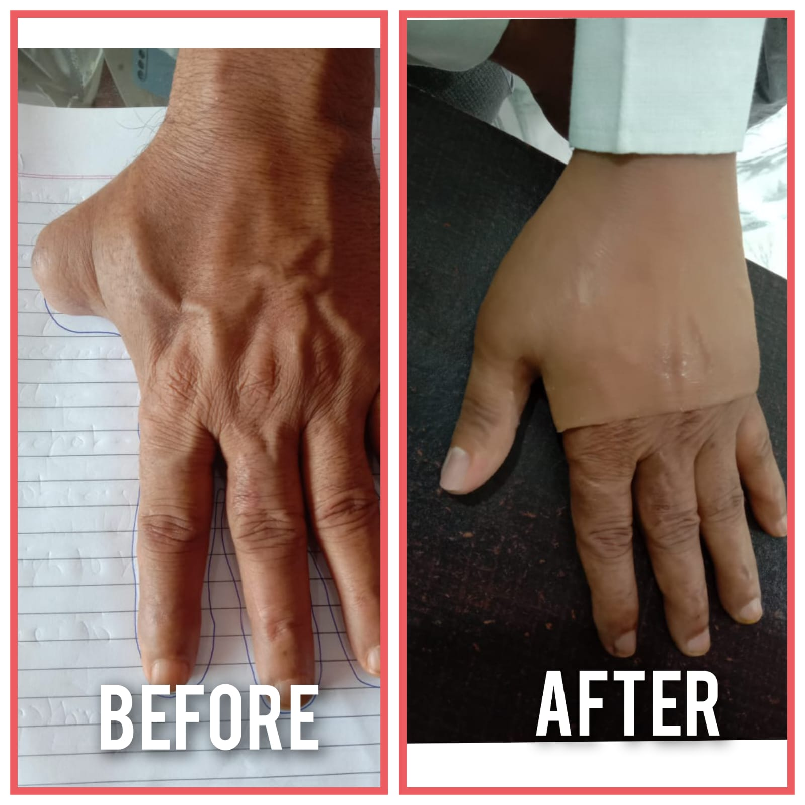 Silicone hand Prosthesis