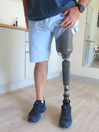 Above knee Prosthesis